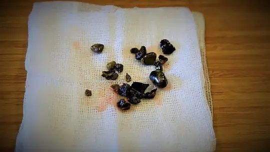 15 yıldır taşıdığı böbrek taşlarından 2 saatlik operasyonla kurtuldu