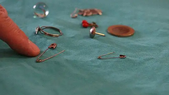 5 aylık bebeğin yuttuğu çengelli iğne operasyonla çıkarıldı