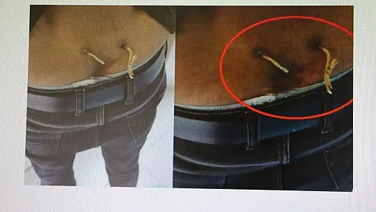 Ağrıları geçsin diye belinden çamaşır ipi geçirmişler