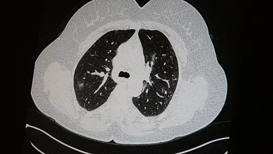 Aşılı ve aşısız olarak koronaya yakalanan 2 gencin akciğer tomografisi korkunç gerçeği gözler önüne serdi